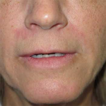 Front view of 56 year old female patient before lip lift surgery