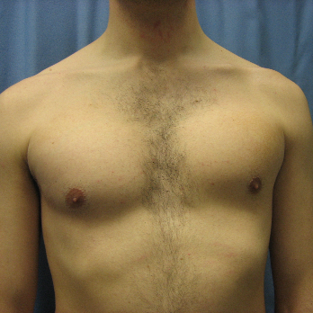 Front view of male patient after pectoral implant surgery
