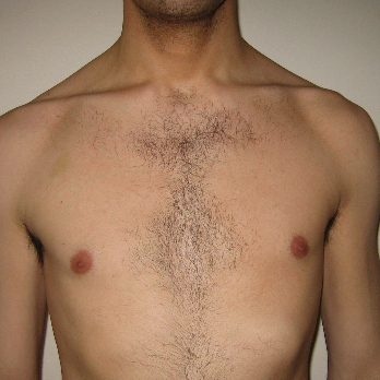 Front view of male patient prior to pectoral implant surgery