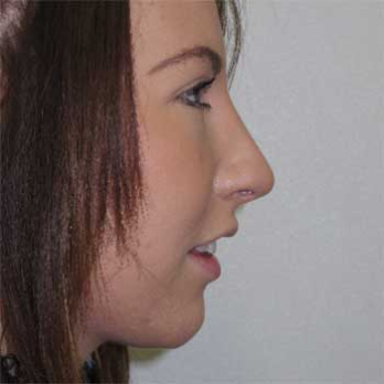 Side profile after rhinoplasty surgery