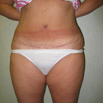 Front view of patient after Abdominoplasty surgery