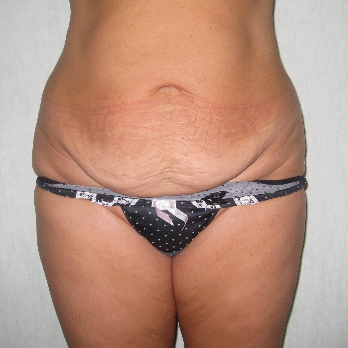 Front view of patient prior to Abdominoplasty surgery