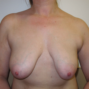 Front view of patient prior to breast lift surgery