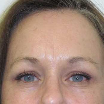 Front view of female patient after browlift surgery