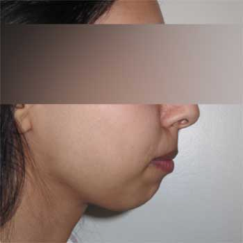 Side view of female patient prior to chin implant surgery