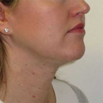 Side view of 39 year old female patient after VASER chin and nick liposuction surgery