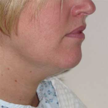 Side view of 39 year old female patient prior to VASER chin and nick liposuction surgery