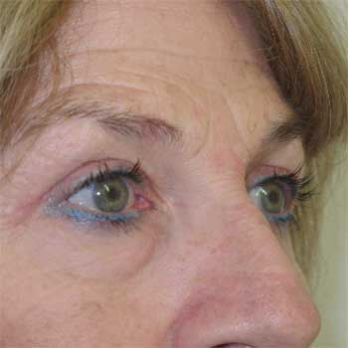 Side view of female patient after eyelid surgery