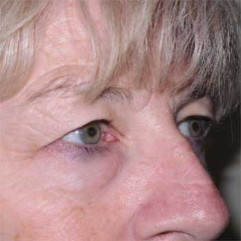 Side view of female patient prior to eyelid surgery