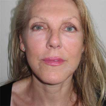 Front view of female patient after Facelift surgery