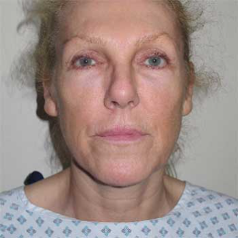 front view of female patient prior to Facelift surgery