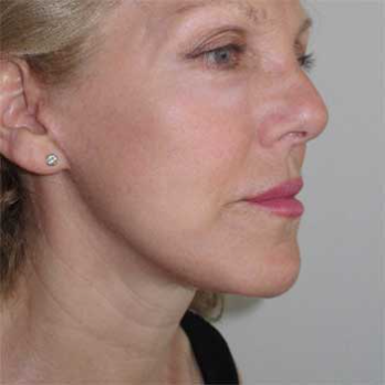 Side view of female paitent after Facelift surgery