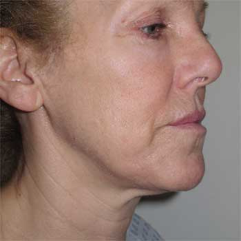 Side view of female paitent before Facelift surgery