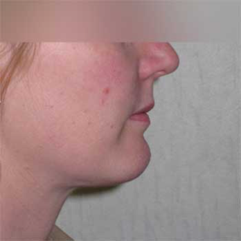 Side view of female patient after Facial Liposculpture surgery