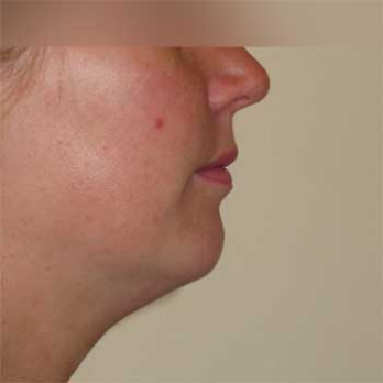 Side view of female patient prior to Facial Liposculpture surgery