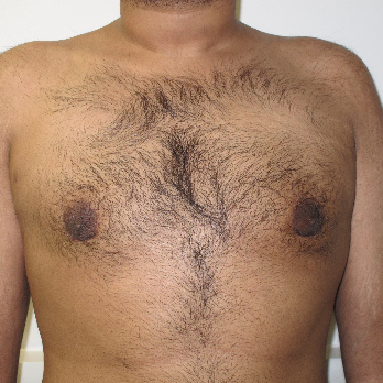 Front view of male patient after gynaecomastia surgery