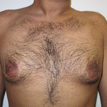 Front view of male patient prior to gynaecomastia surgery