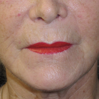 Front view of patient after Fractional laser resurfacing treatment