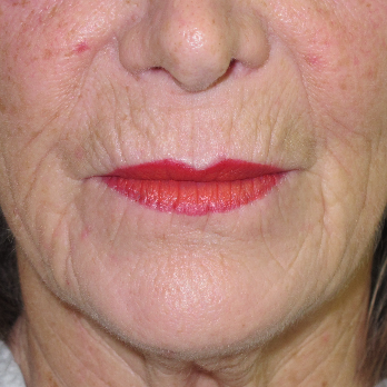 Front view of patient prior to Fractional laser resurfacing treatment