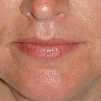 Front view of 48 year old female after Lip Lift surgery