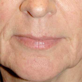 Front view of 48 year old female prior to Lip Lift surgery