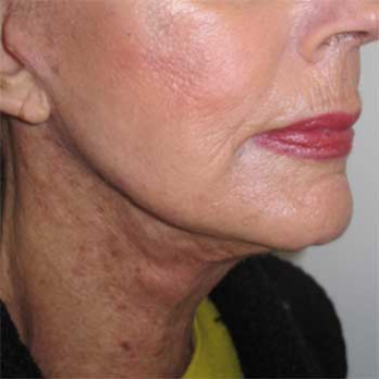 Three quarter view of female patient after necklift and lower faclift surgery