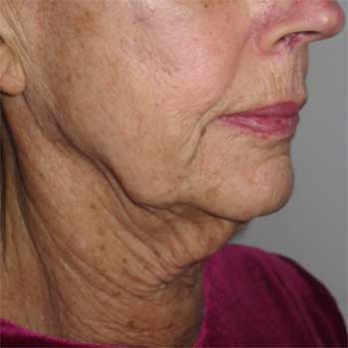 Three quarter view of female patient prior to necklift and lower faclift surgery