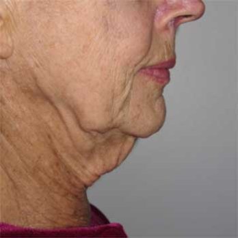 Side view of female patient before neck lift and lower facelift surgery