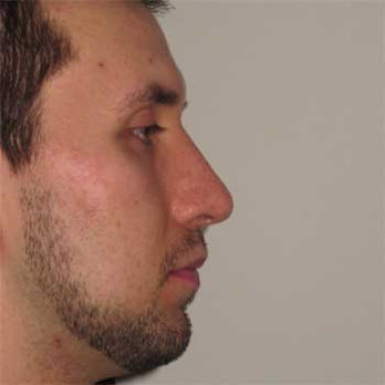 Side profile after rhinoplasty surgery