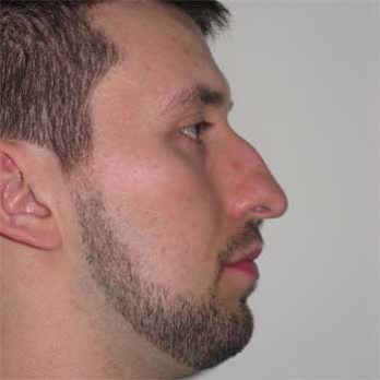 Side profile before rhinoplasty surgery