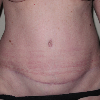 Front view of patient after Abdominoplasty surgery