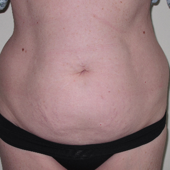 Front view of patient prior to Abdominoplasty surgery