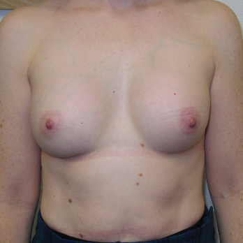 Front view of patient after Breast Augmentation surgery