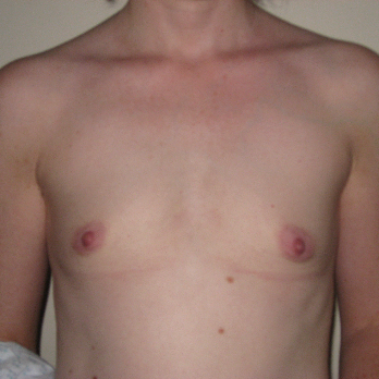 Front view of patient prior to Breast Augmentation surgery