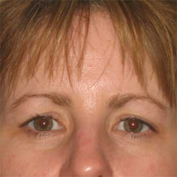 Front view of female patient prior to browlift surgery