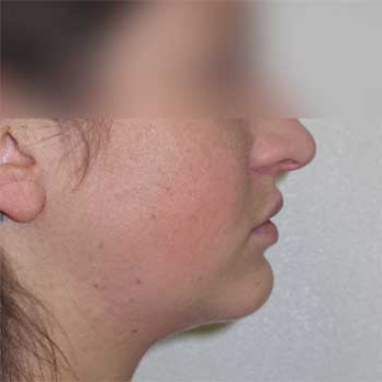 Side view of female patient after chin implant surgery