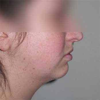 Side view of female patient prior to chin implant surgery