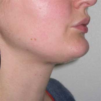 Side view of female patient after VASER chin lipousction surgery