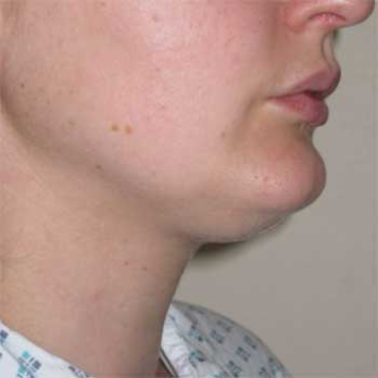 Side view of female patient prior to VASER chin lipousction surgery