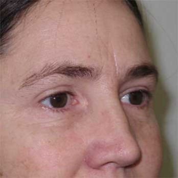 Side view of female patient after eyelid surgery