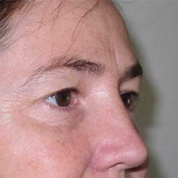 Side view of female patient prior to eyelid surgery