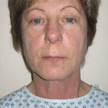 front view of female patient prior to Facelift surgery