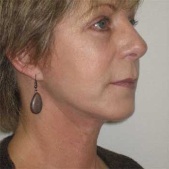 Side view of female paitent after Facelift surgery