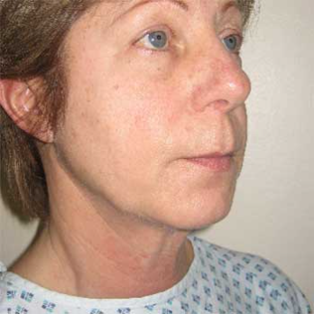 Side view of female paitent before Facelift surgery