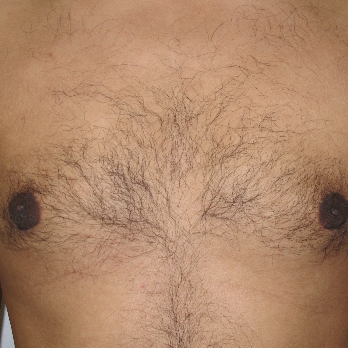 Front view of male patient after gynaecomastia surgery