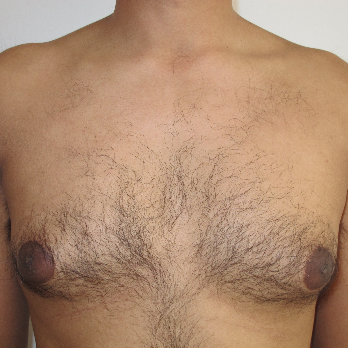 Front view of male patient prior to gynaecomastia surgery