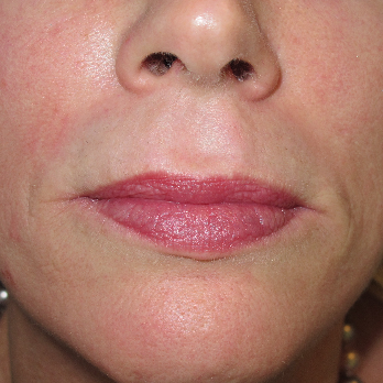 Front view of patient after Fractional laser resurfacing treatment