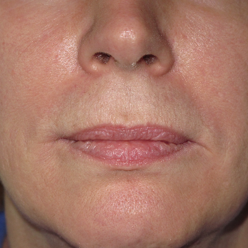 Front view of patient prior to Fractional laser resurfacing treatment