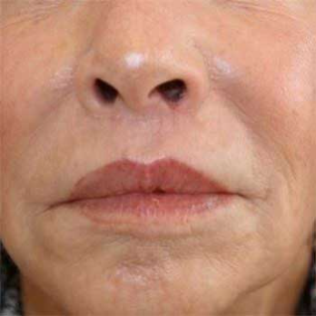 Front view of 64 year old female patient after Lip Lift surgery