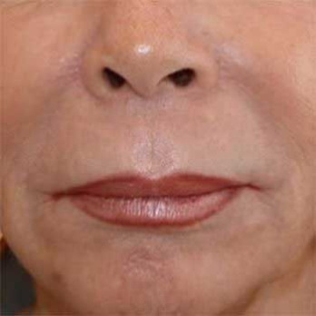 Front view of 64 year old female patient prior to Lip Lift surgery